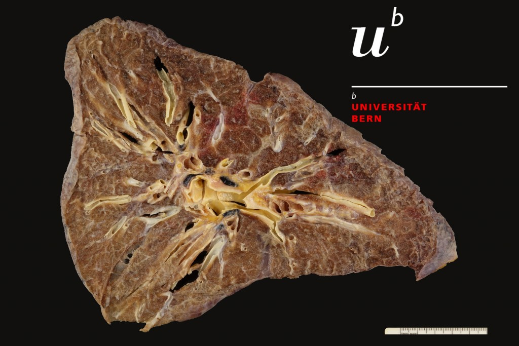 Emphysema of the lung 300dpiGood