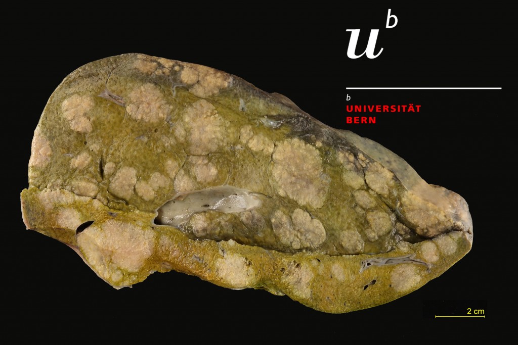 Liver metastases 300dpiGood