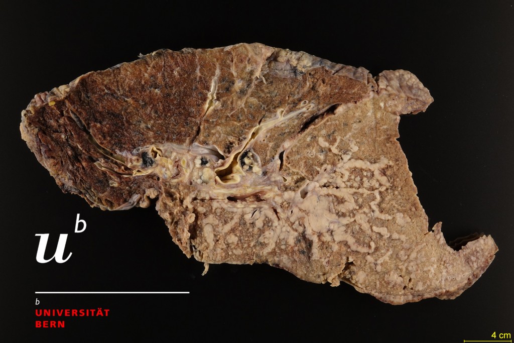 Primary adenocarcinoma of the lung 300dpiGood