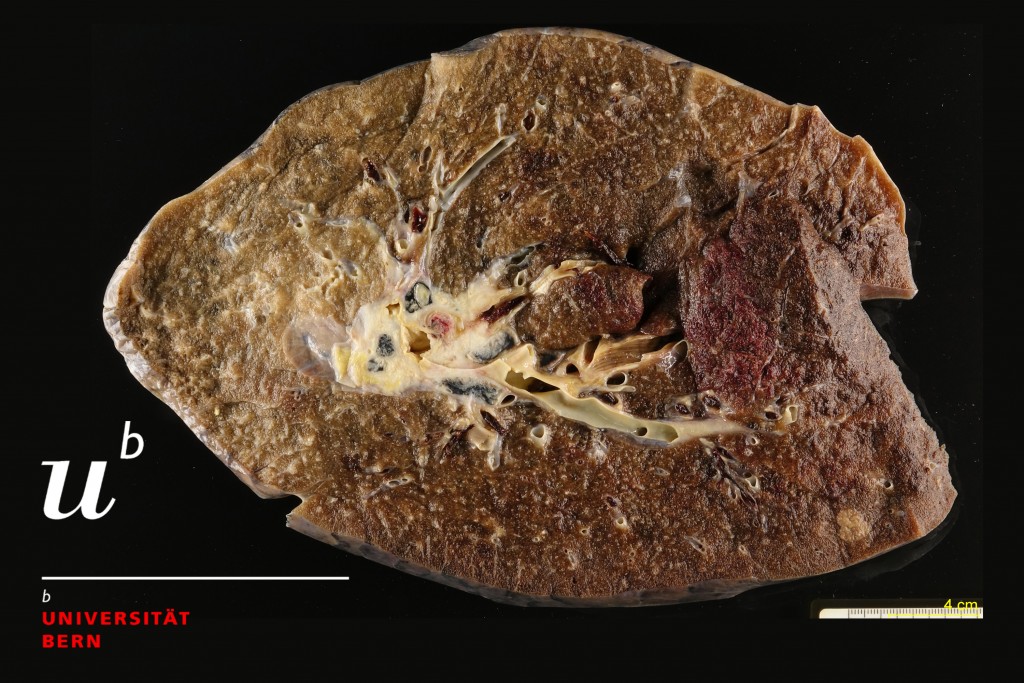 Primary squamous cell carcinoma of the lung 300dpiGood