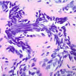 Benign Breast Fibroadenoma