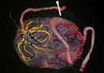 SPOT PathStand 24 Image of Twin Placenta After Colored Dye Injection